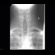 Processus megatransversus, rudimentary rib: X-ray - Plain radiograph
